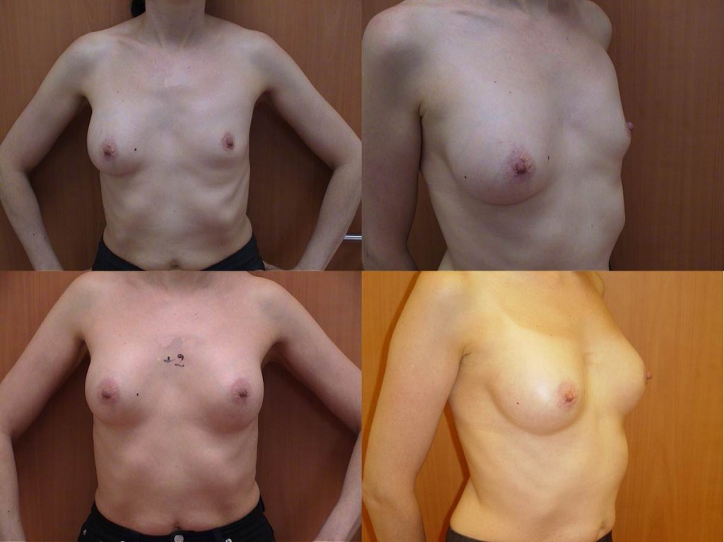 Dégonflement Prothèse av et après