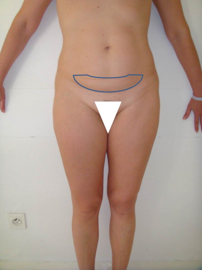 Fig 2 Minilift abdominal