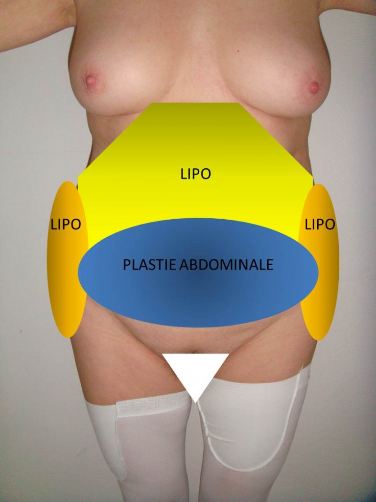 Fig 3 Schema PA + Lipo