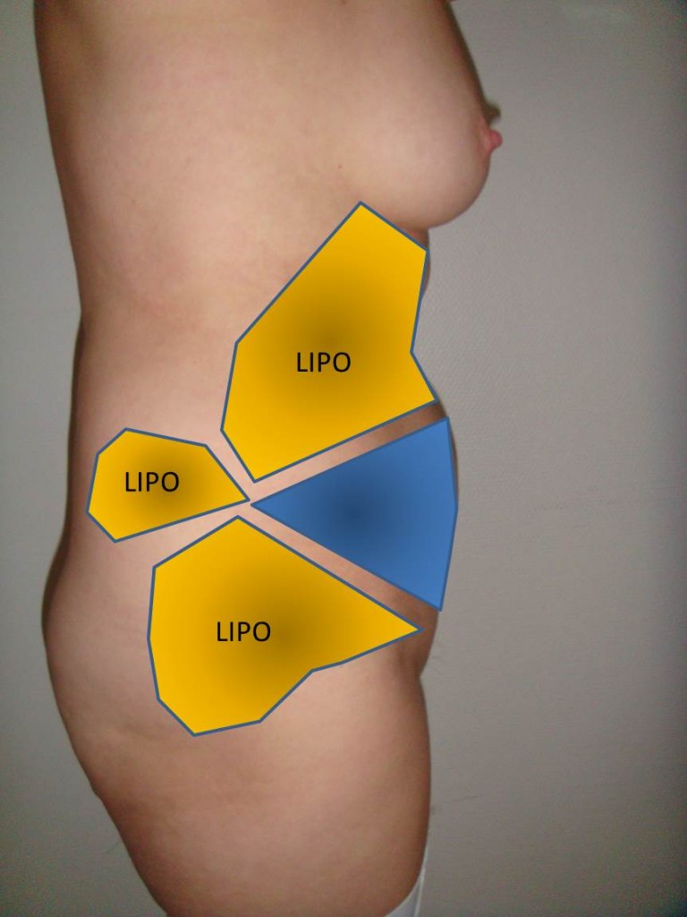 Fig 4 Schema PA + Lipo