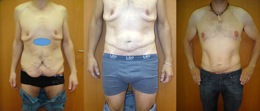 bodylift-face