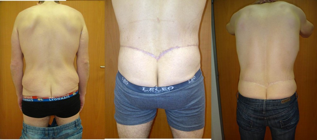 bodylift-posterieut