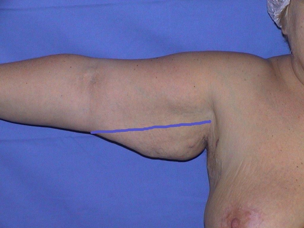 brachio-incision