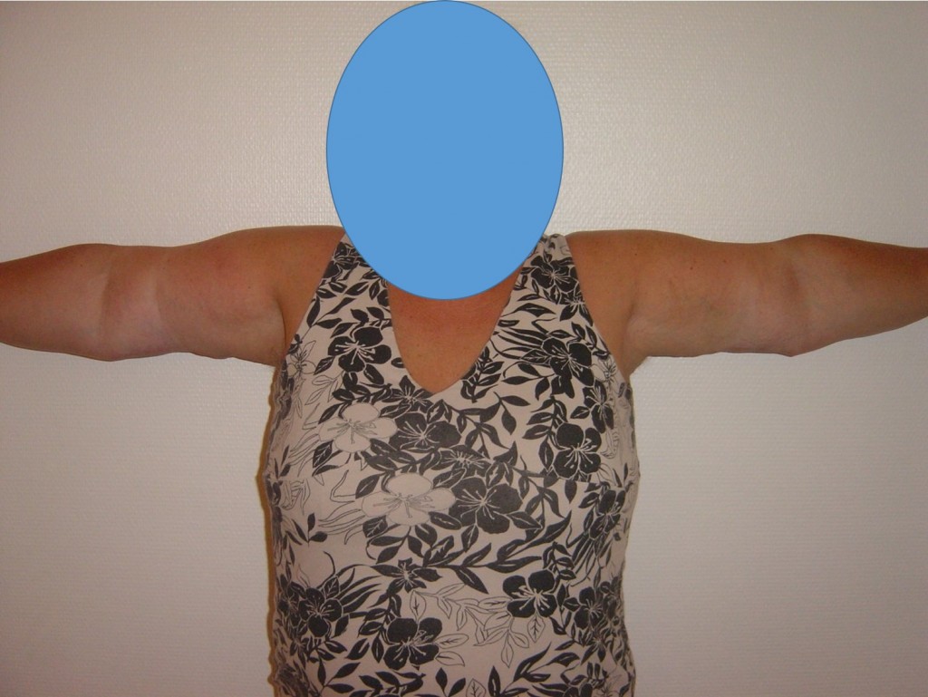 brachioplastie-face-post
