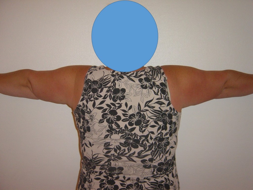 brachioplastie-post-post