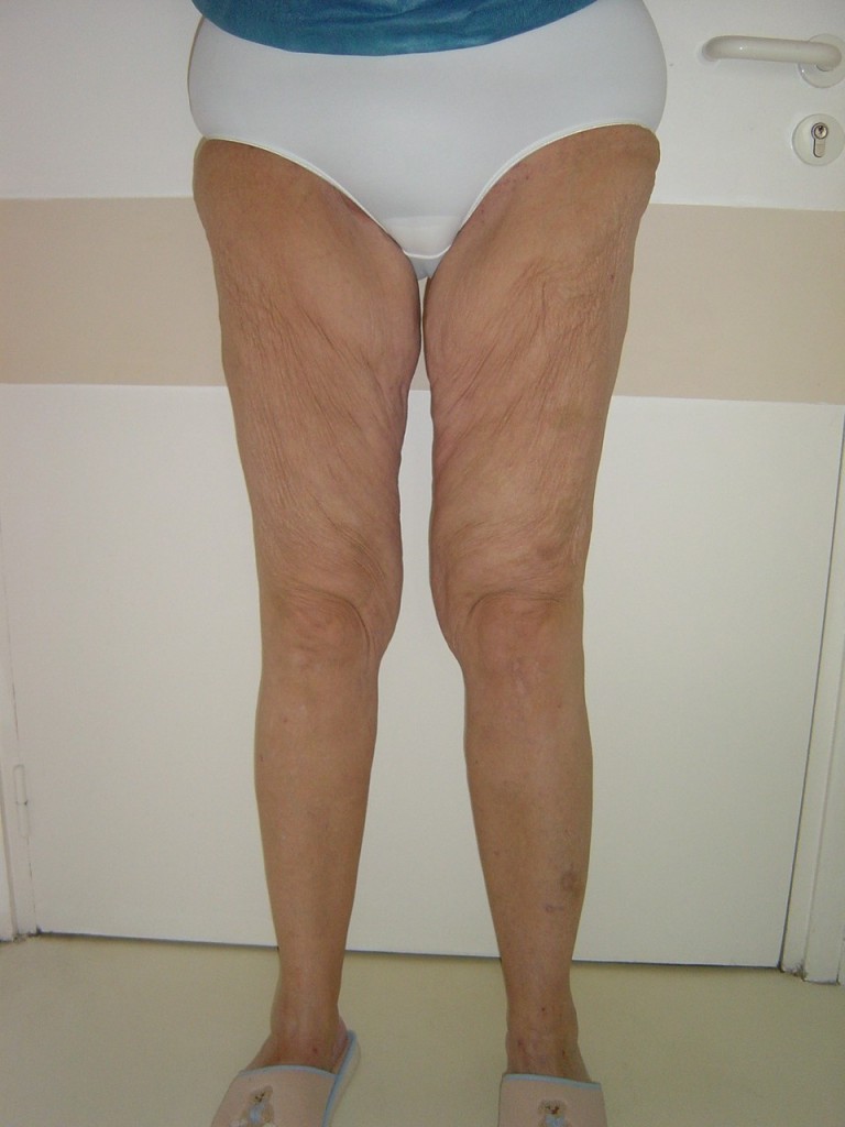cruroplastie-verticale-preop