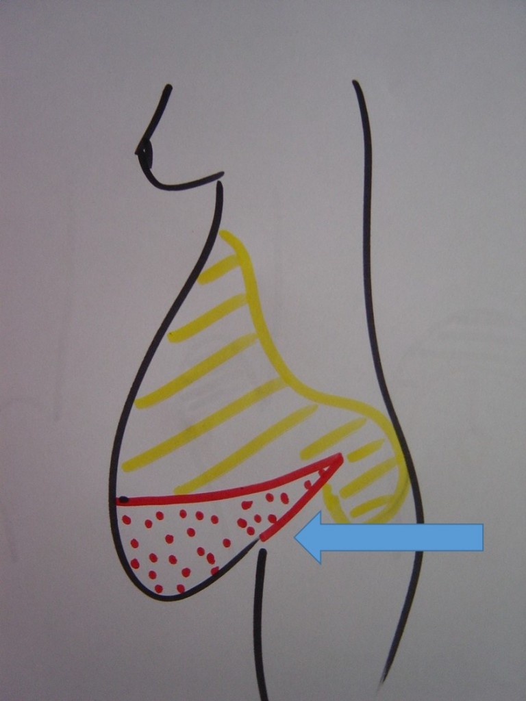 pa-lipo-schema-profil