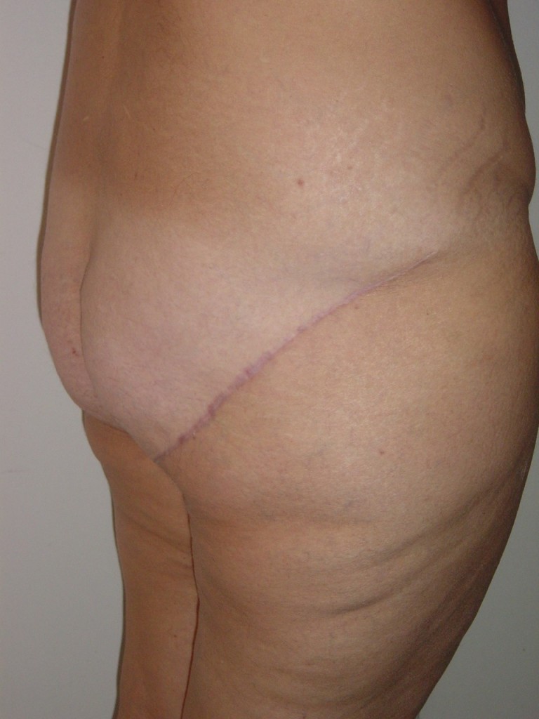 trochanteroplastie-post