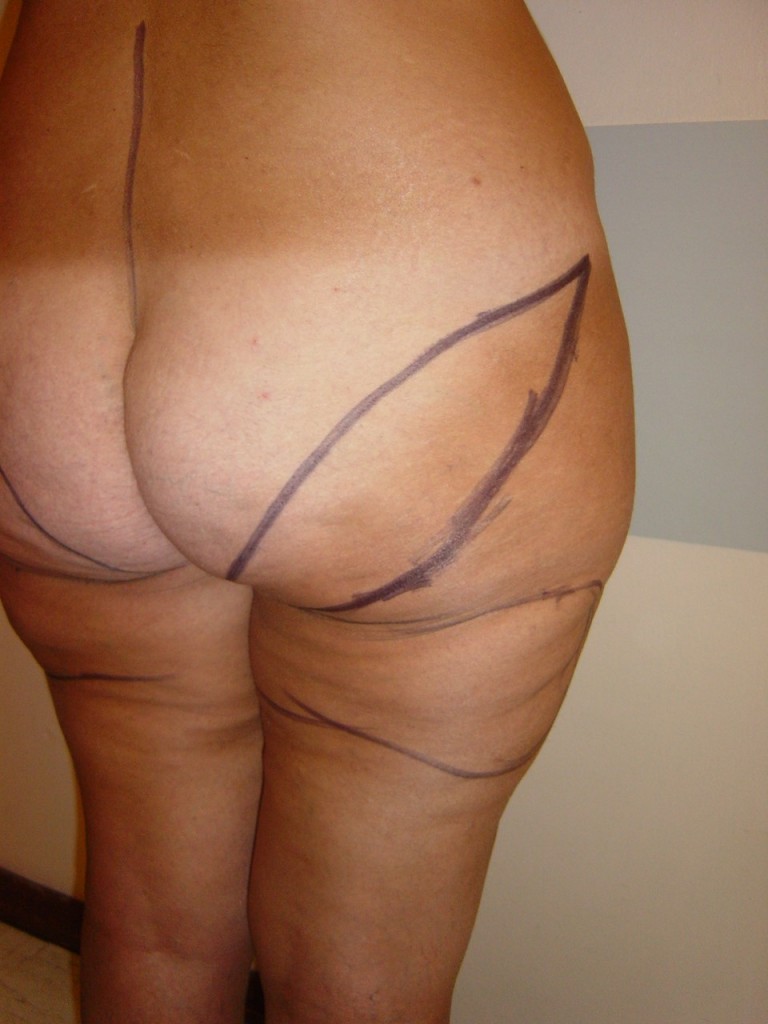 trochanteroplastie-pre
