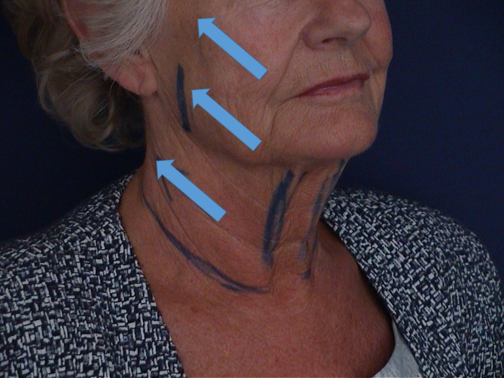 vecteur-lifting-facial