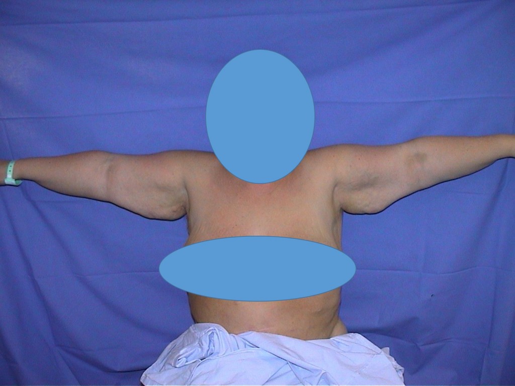 brachioplastie-face-pre