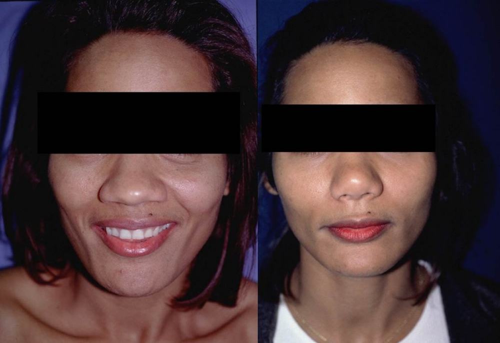 Avant / après · Rhinoplastie