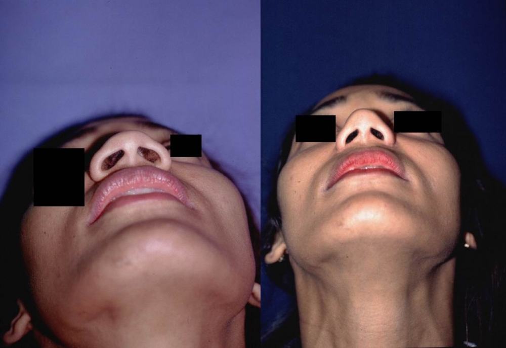 Avant / après · Rhinoplastie