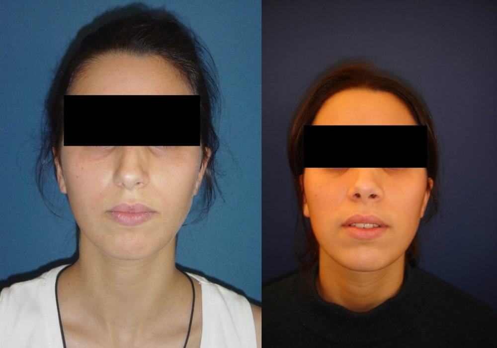 Avant / après · Rhinoplastie