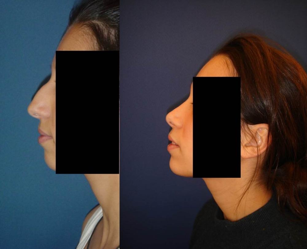 Avant / après · Rhinoplastie