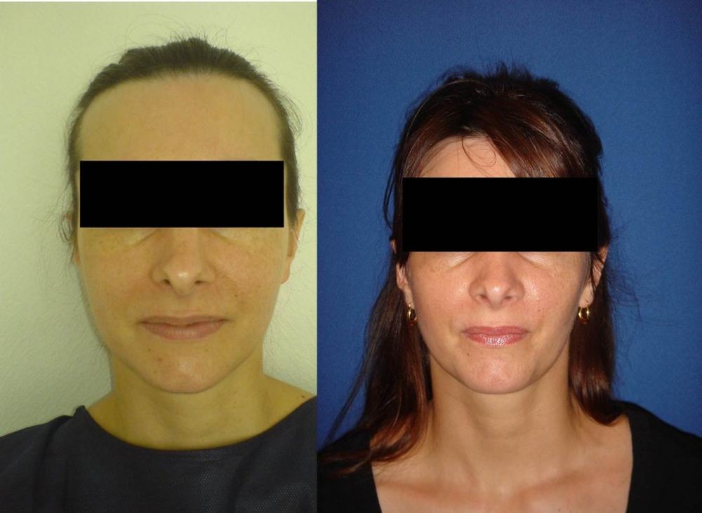 Avant / après · Rhinoplastie