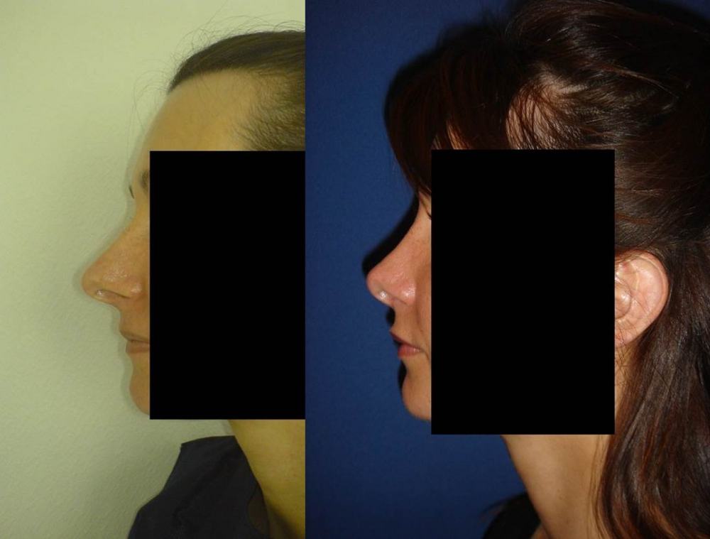 Avant / après · Rhinoplastie