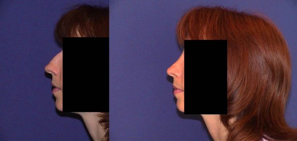 Avant / après · Rhinoplastie