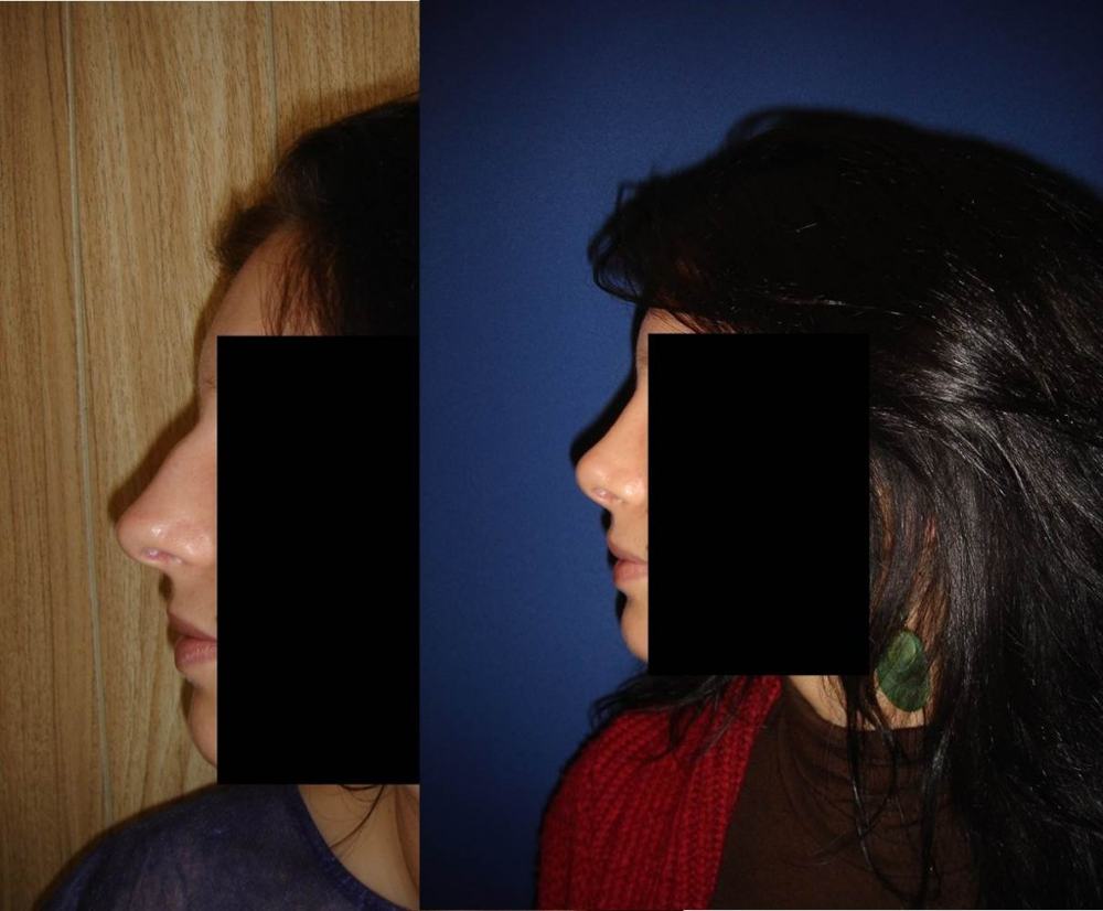 Avant / après · Rhinoplastie
