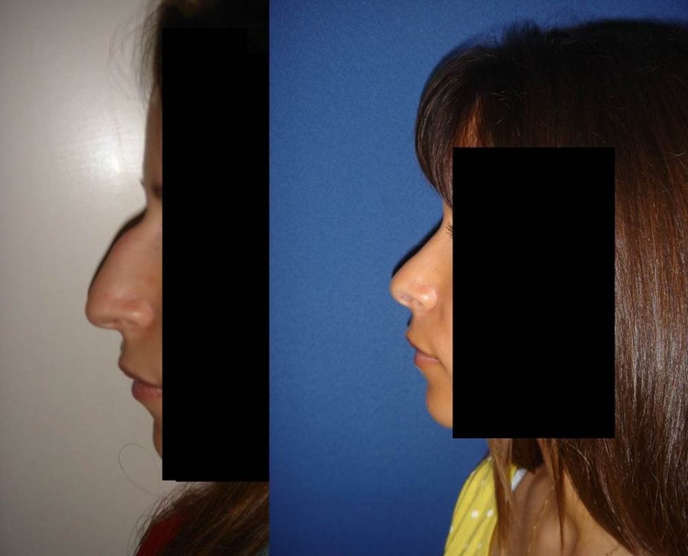 Avant / après · Rhinoplastie