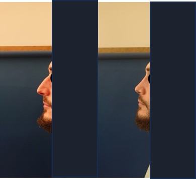 Avant / après · Rhinoplastie
