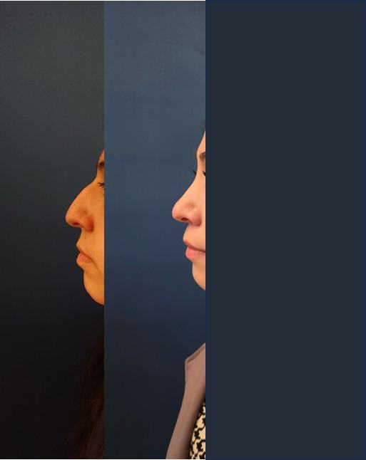 Avant / après · Rhinoplastie