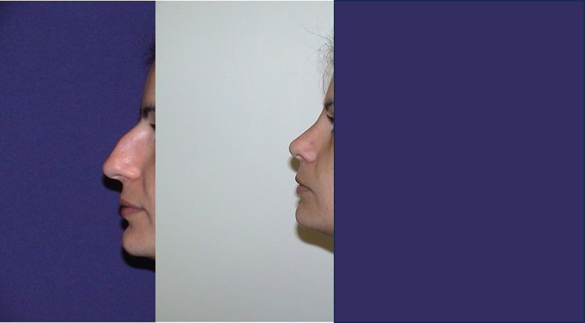 Avant / après · Rhinoplastie