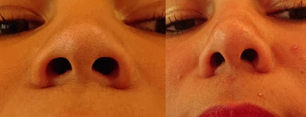 Avant / après · Rhinoplastie