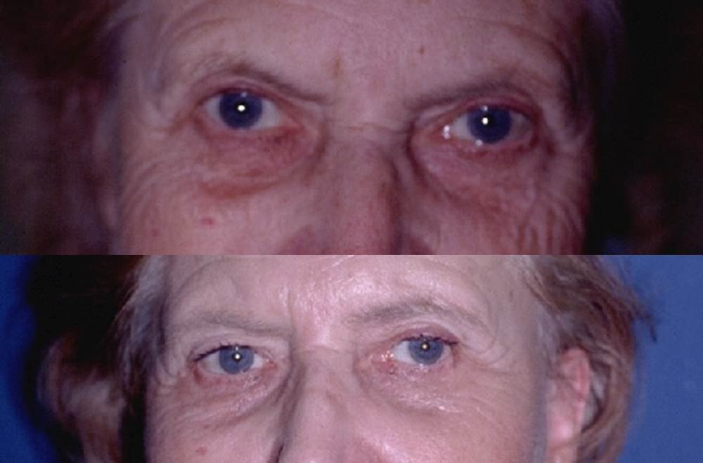Avant / après · Blépharoplastie