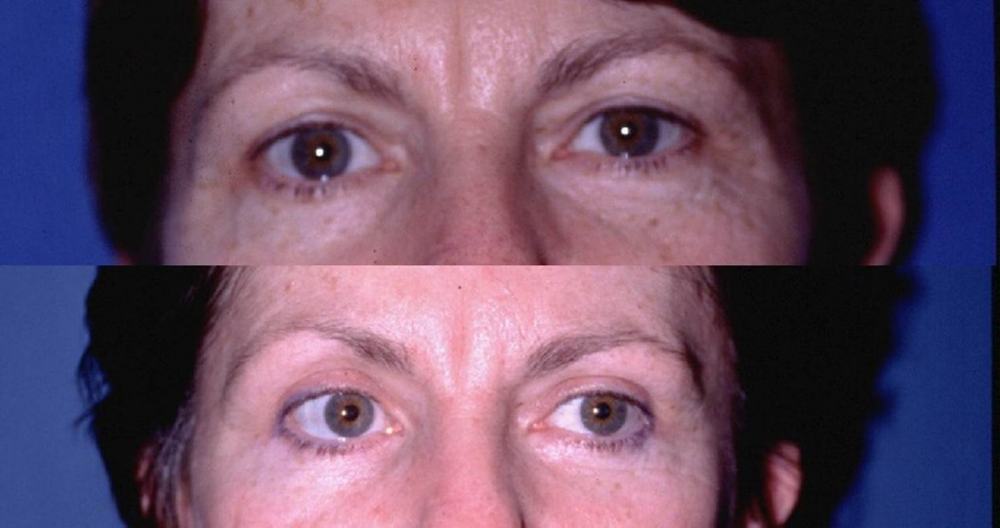 Avant / après · Blépharoplastie