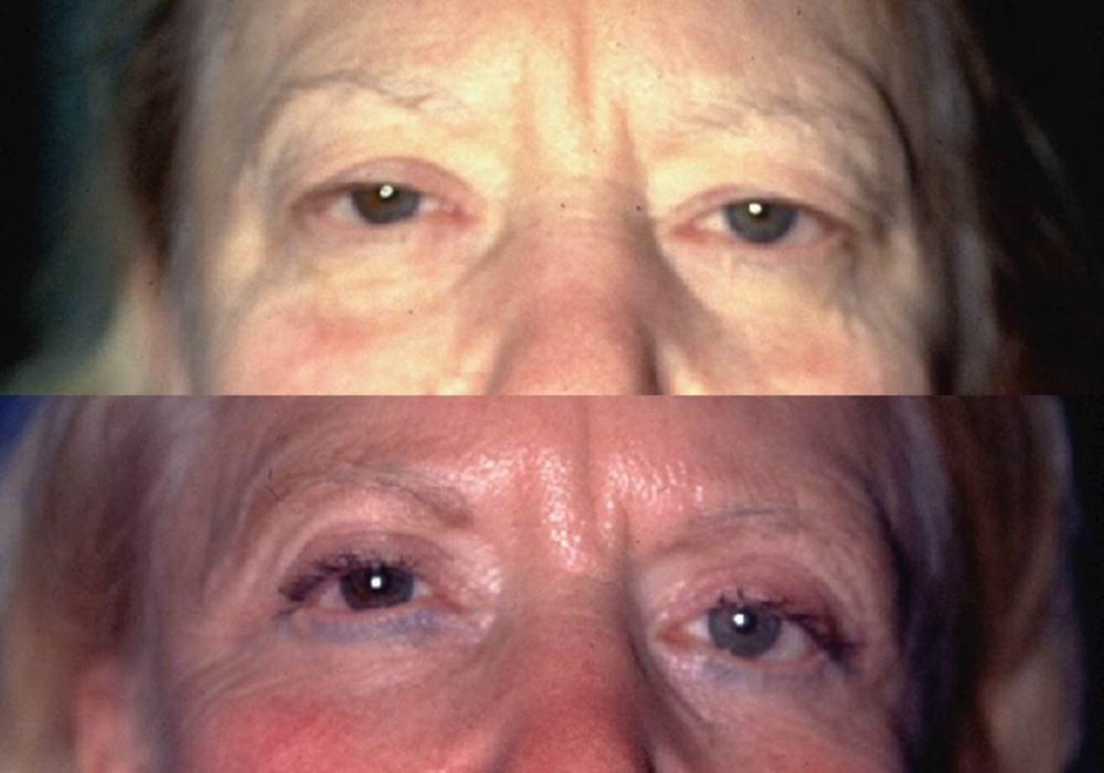 Avant / après · Blépharoplastie