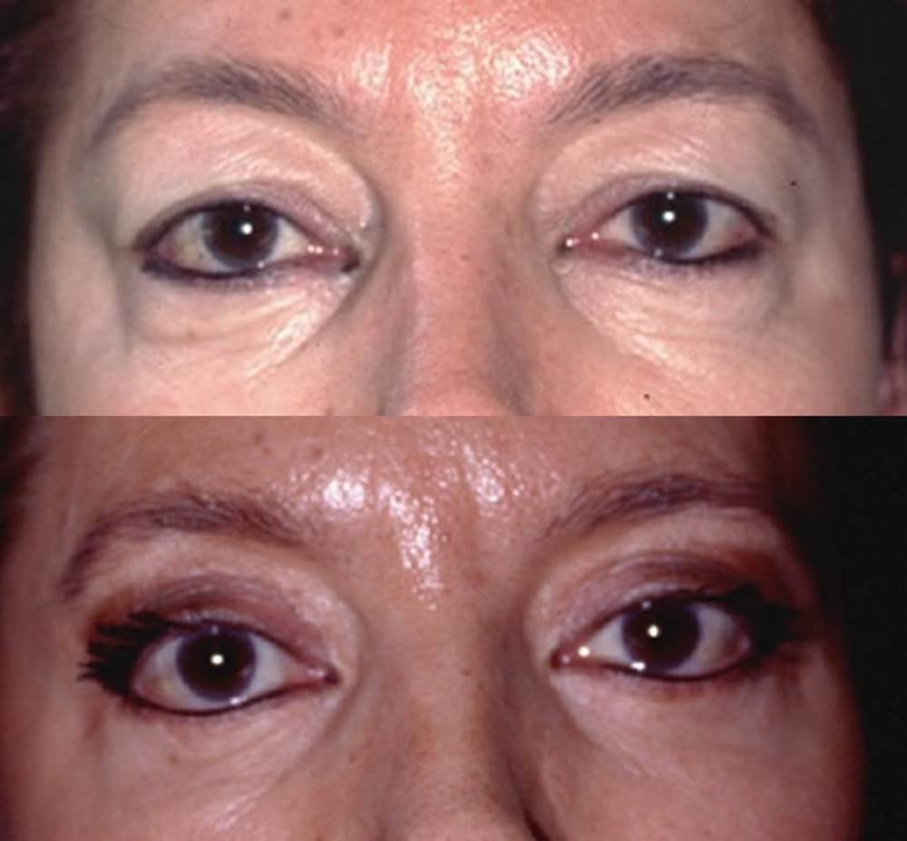 Avant / après · Blépharoplastie