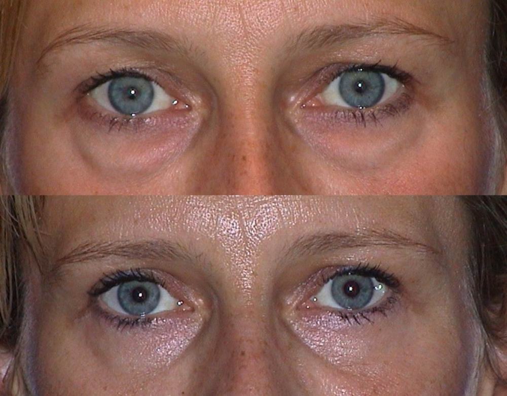 Avant / après · Blépharoplastie