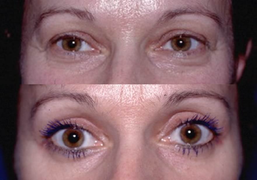 Avant / après · Blépharoplastie
