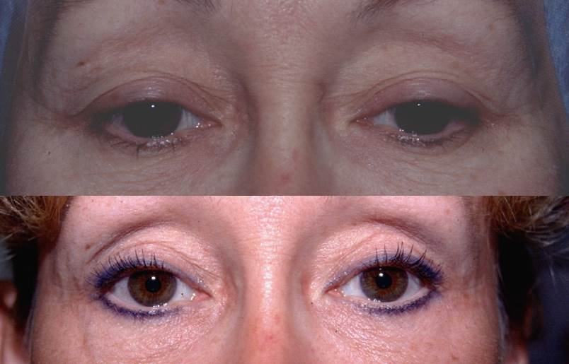 Avant / après · Blépharoplastie