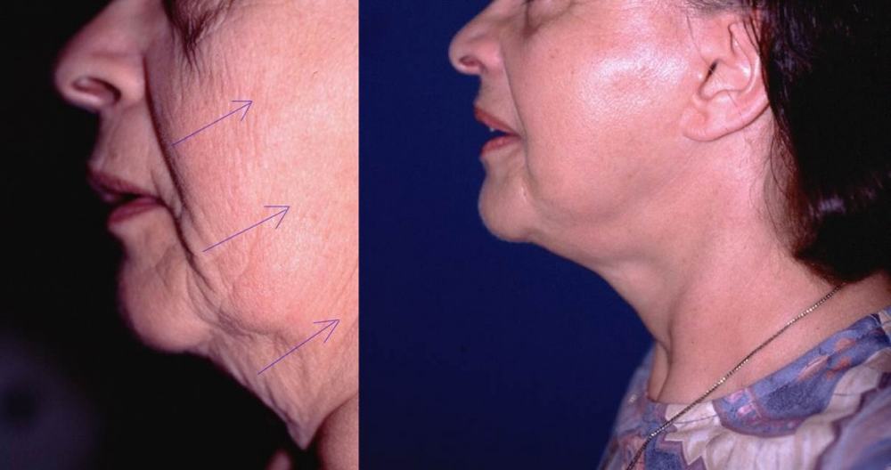 Avant / après · Lifting cervico-facial