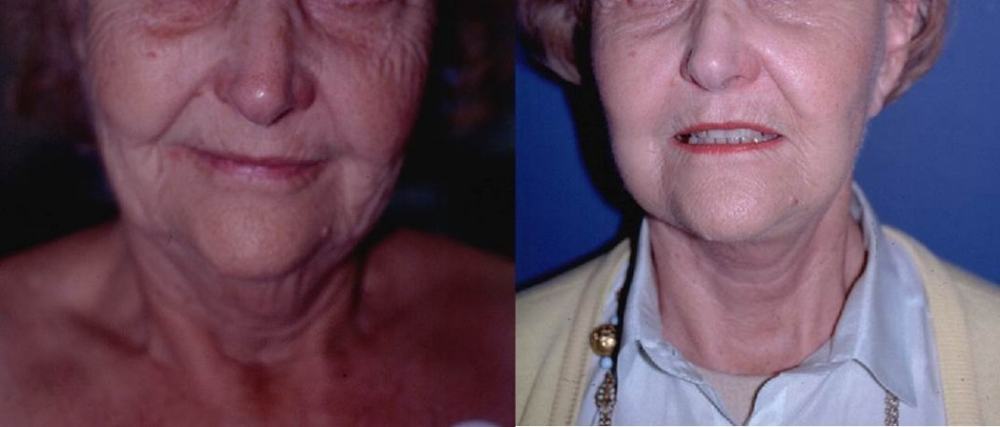 Avant / après · Lifting cervico-facial