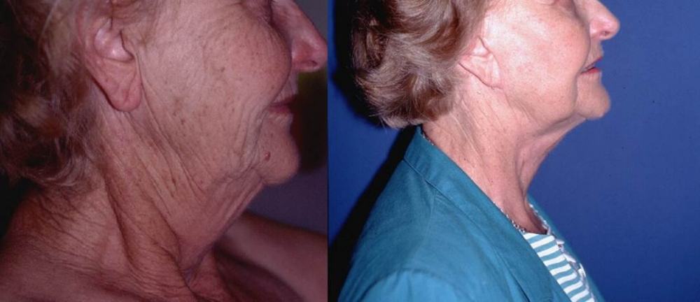 Avant / après · Lifting cervico-facial