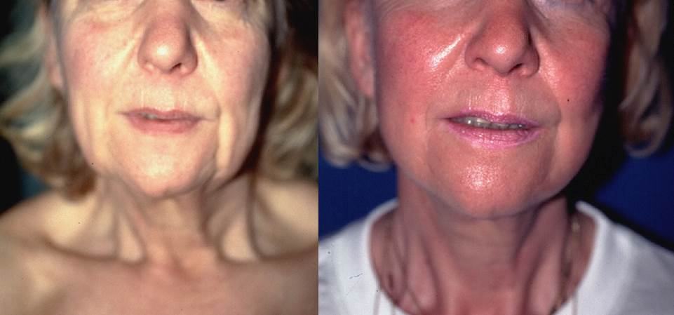 Avant / après · Lifting cervico-facial
