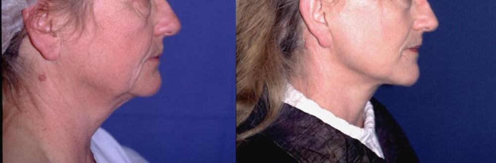 Avant / après · Lifting cervico-facial