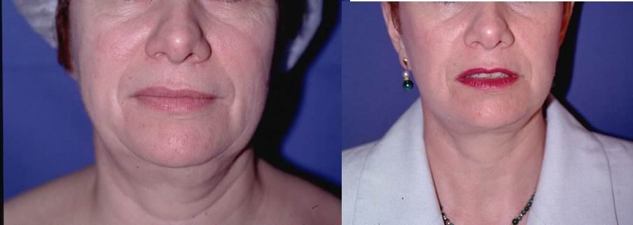 Avant / après · Lifting cervico-facial