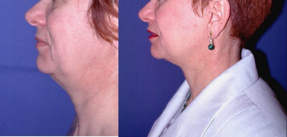 Avant / après · Lifting cervico-facial