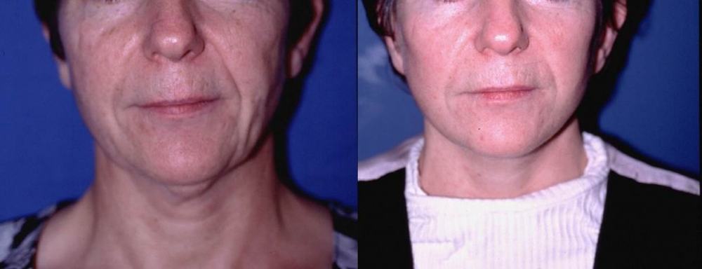 Avant / après · Lifting cervico-facial