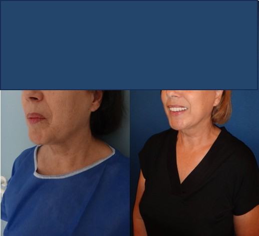 Avant / après · Lifting cervico-facial