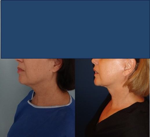 Avant / après · Lifting cervico-facial