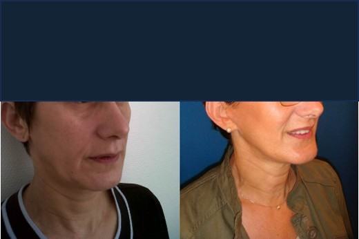 Avant / après · Lifting cervico-facial