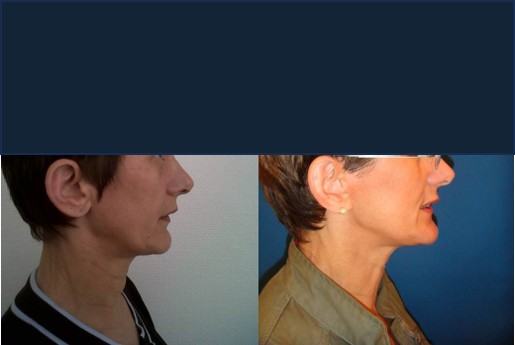 Avant / après · Lifting cervico-facial