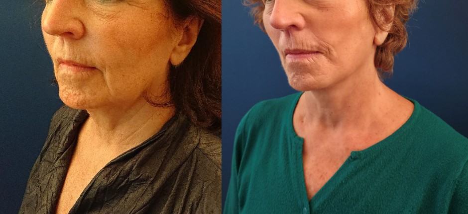 Avant / après · Lifting cervico-facial