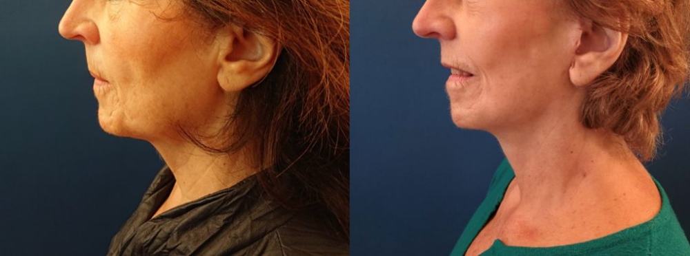 Avant / après · Lifting cervico-facial