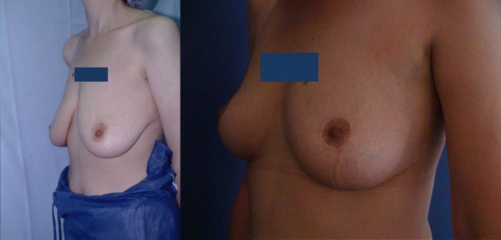 Avant / après · Plastie mammaire
